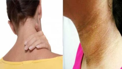 इन 5 खास घरेलू टिप्स से गर्दन को बनाएं साफ और बेदाग, दूर भागेगा जिद्दी कालापन