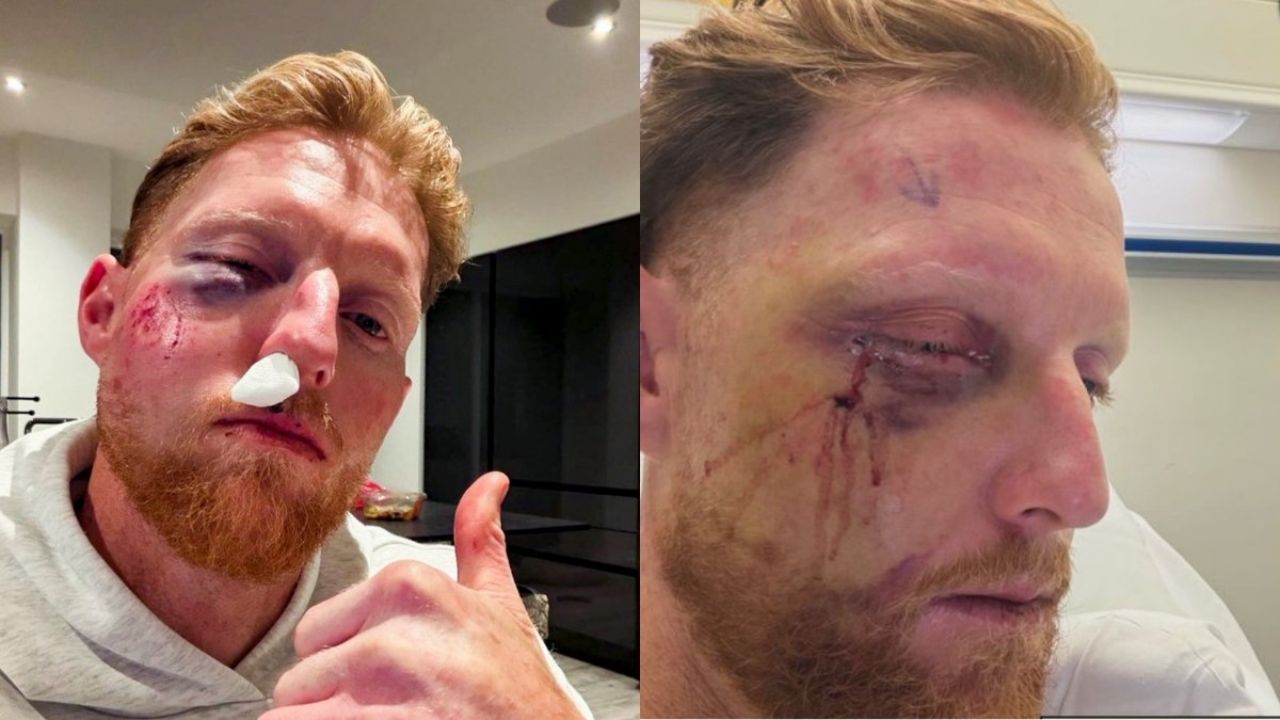 एशेज के बाद बेन स्टोक्स की हुई सर्जरी, चेहरे पर लगी थी गेंद; सोशल मीडिया पर शेयर की फोटो