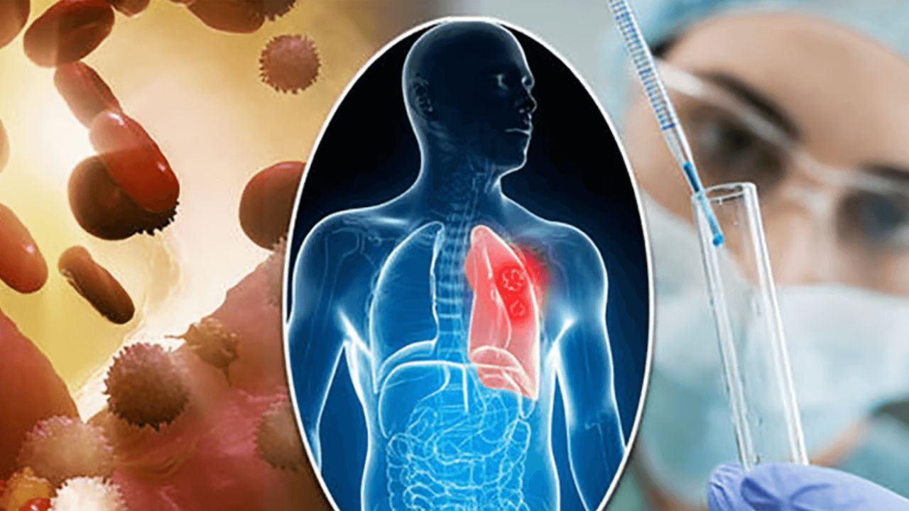 विश्व कैंसर दिवस: भंडारा में 93 मुख कैंसर के नए मरीज, एक साल में 152 नए केस; तंबाकू बना बड़ा कारण