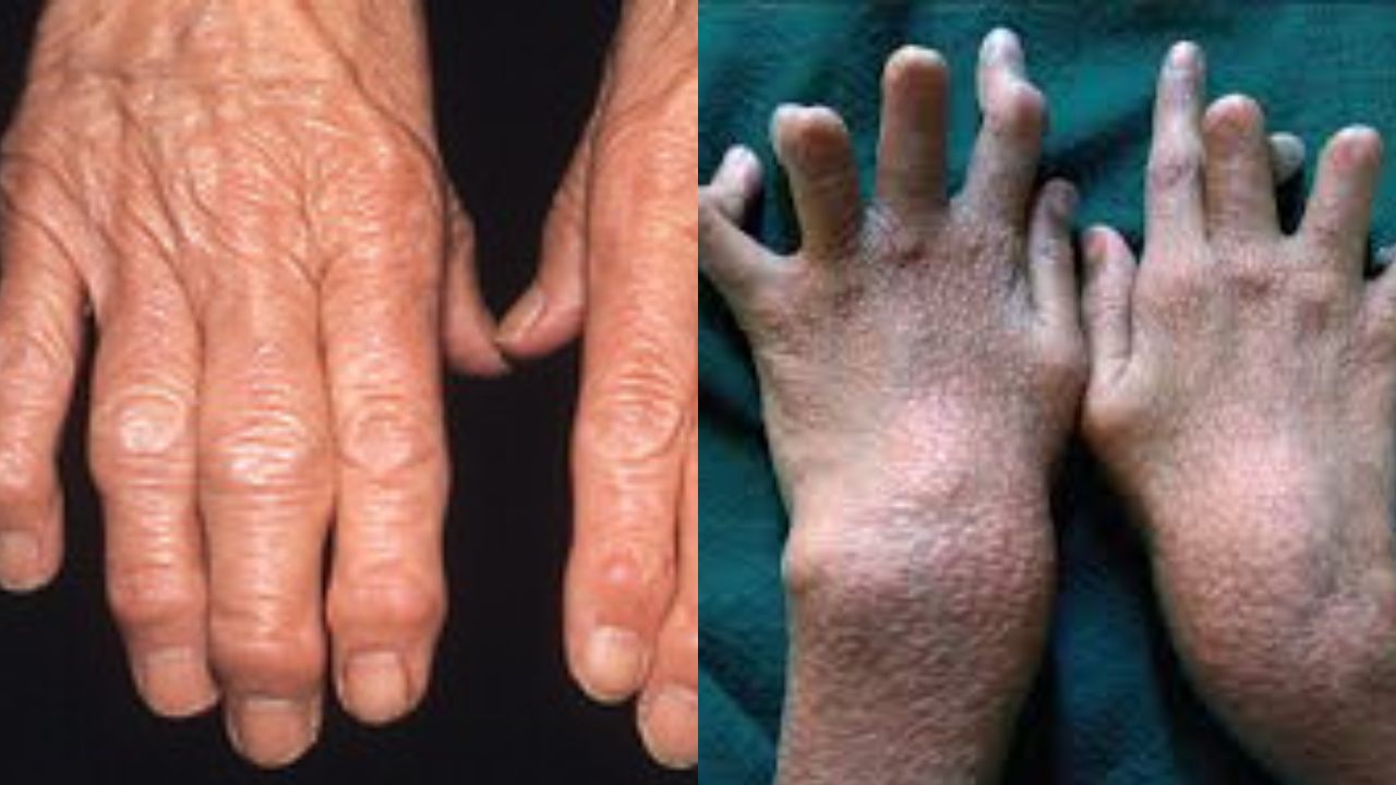 भंडारा में कुसुम अभियान: 2027 तक कुष्ठमुक्त महाराष्ट्र का लक्ष्य, 218 हाई रिस्क साइट्स पर जांच शुरू